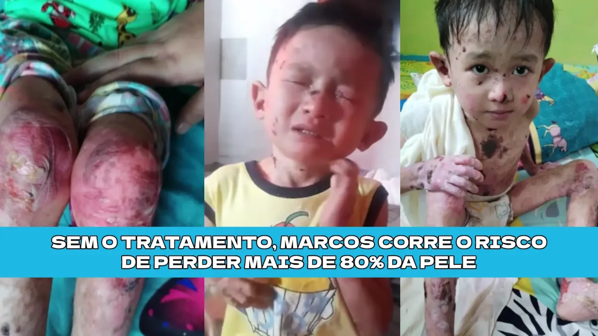 Ajude o Marcos a Vencer a Dor